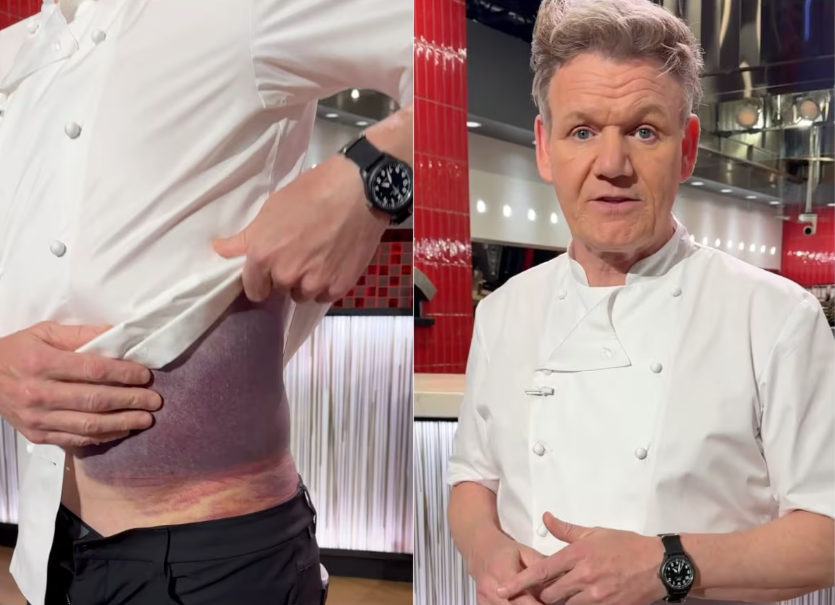 Gordon Ramsay shares important message after potentially fatal accident.